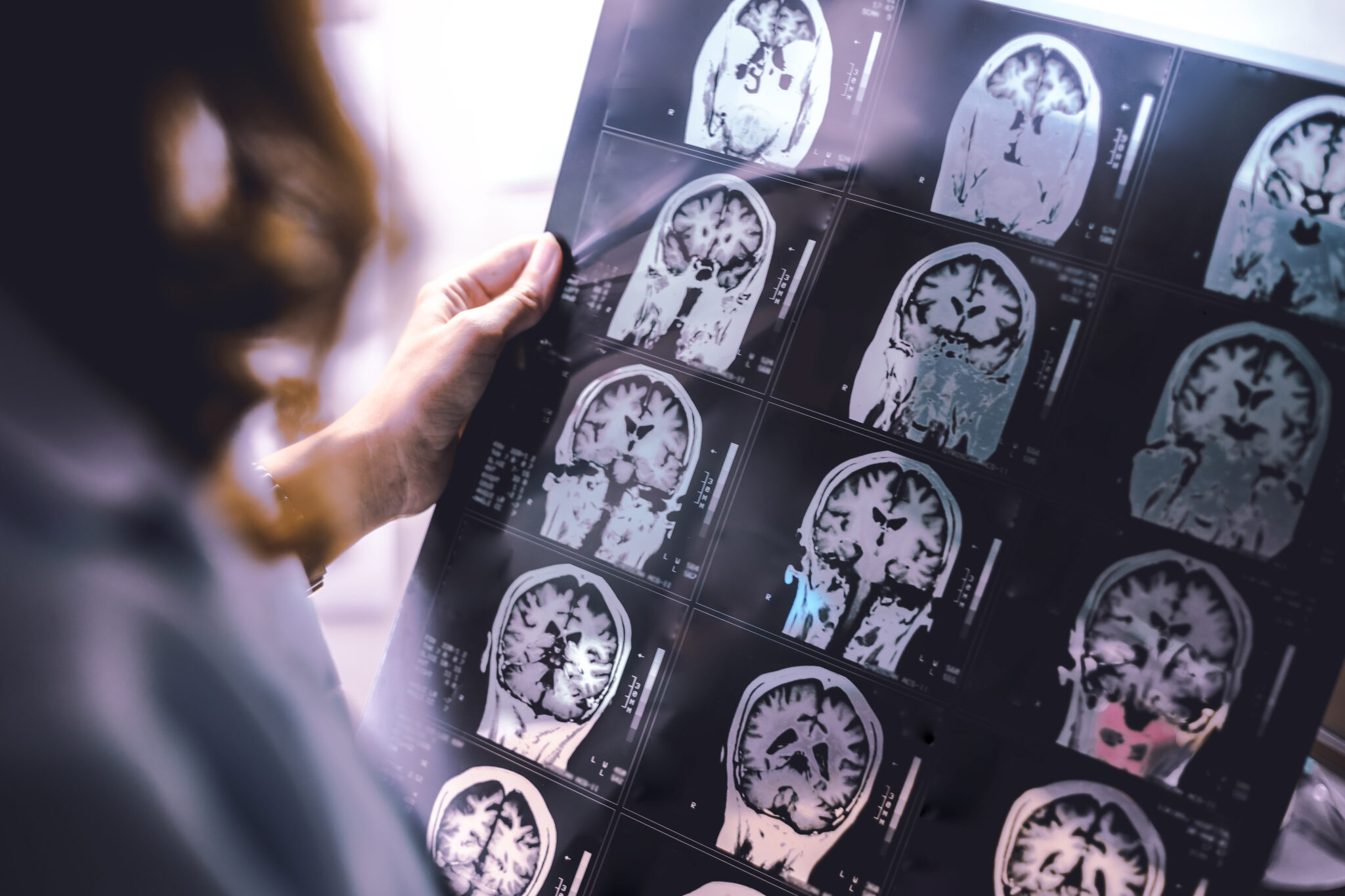 What Causes a Brain Stem Injury? | Toronto Law Blog